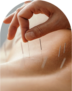 Acupuncture